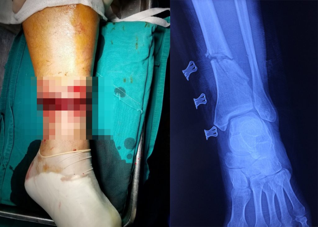 máy quật cỏ an toàn